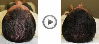 El Dr Benzaquén habla sobre los tratamientos de la alopecia