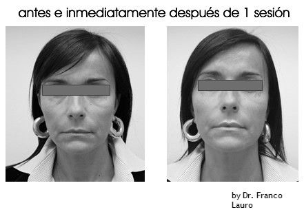 retensado piel con hifu